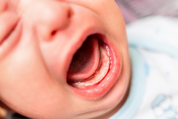 Lidah Bayi Putih? Ini Penyebab dan Cara Mengatasinya