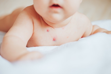 Waspada! Bahaya Cacar Monyet atau Monkeypox pada Anak
