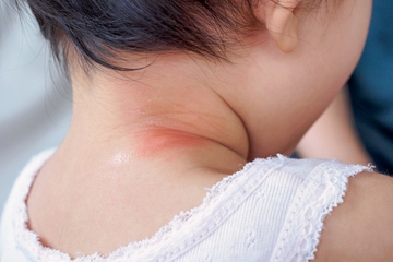 Ini 5 Penyebab Ruam di Leher Bayi dan Cara Mengatasinya
