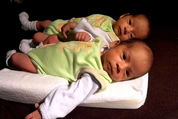 Ini Penyebab Bayi Lahir Kembar Siam