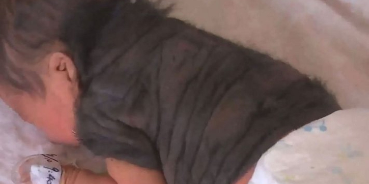 Astaga, Bayi 'Werewolf' Lahir di China!