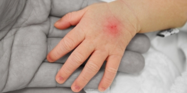 Mengenal Septicaemia (2)