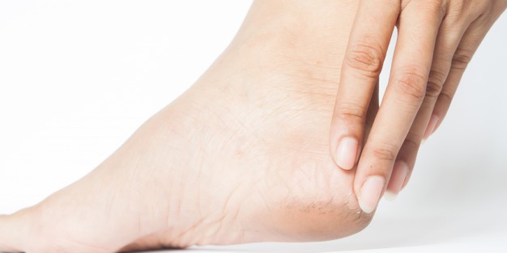 Moms, Ini Cara Mudah Atasi Cracked Heels