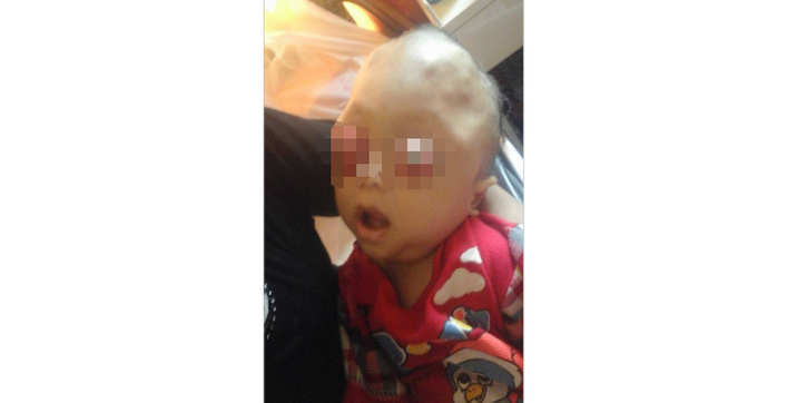 Bayi Asal Lampung Terserang Tumor Mata