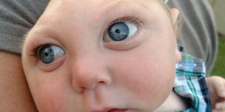 Bayi Tanpa Tengkorak Kepala Bertahan Hidup