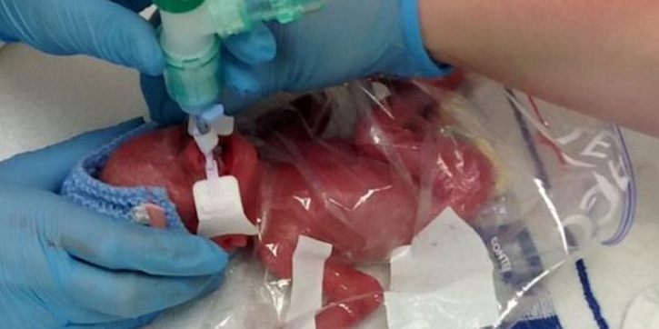 Lucia, Bayi Prematur yang Bertahan Hidup