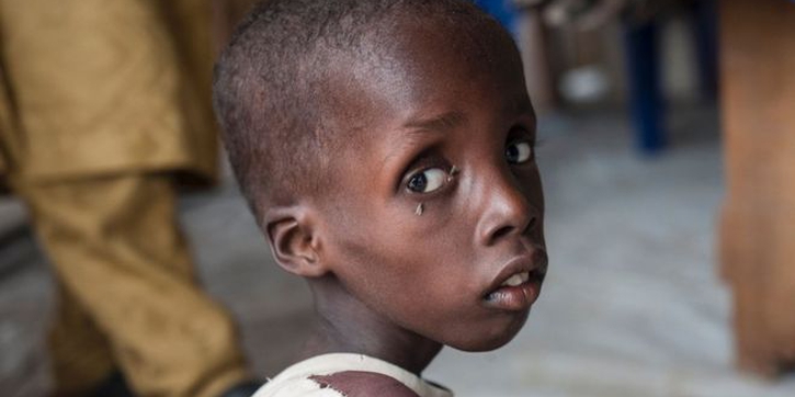 Ribuan Anak Nigeria Menderita Kekurangan Gizi Akut