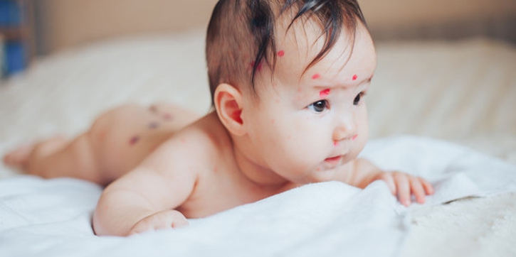 Waspadai 7 Masalah Kulit pada Bayi Baru Lahir