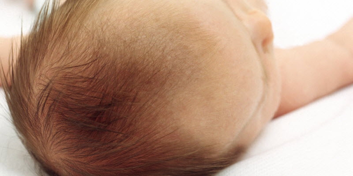 Mengenal Kerak Topi pada Bayi