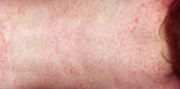 Waspadai Infeksi Virus Roseola 