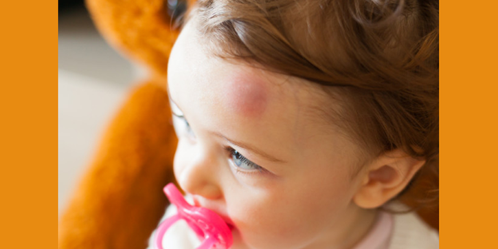 5 Langkah Ampuh untuk Mengatasi Benjol pada Bayi