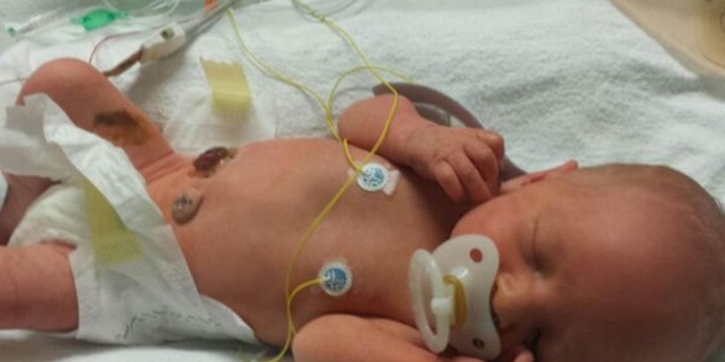 Bayi Lahir Dengan Gastroschisis