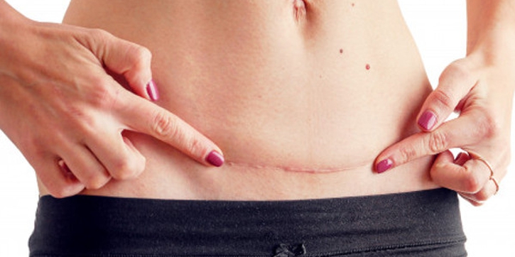 5 Fakta Penting seputar Keloid Pasca Operasi Caesar