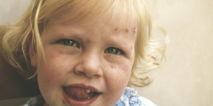 Waspada Impetigo Menyerang Si Kecil! 