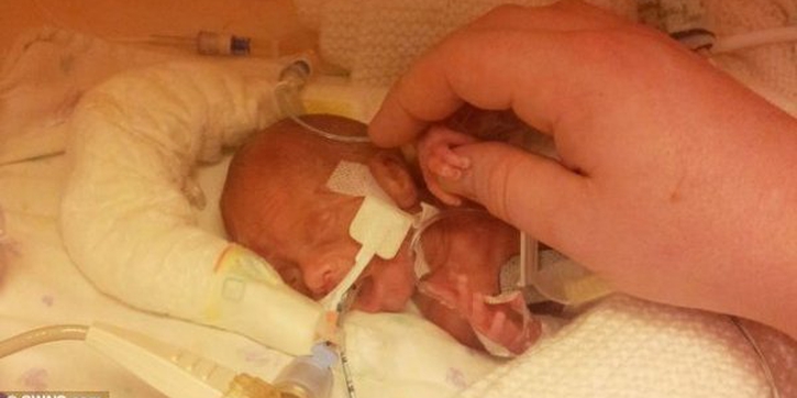 Kisah Kelahiran Bayi Prematur 1 Kilogram