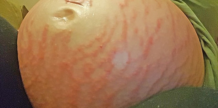 Perubahan Hormon Membuat Perut Bumil Ini Penuh Ruam
