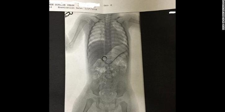 Sebuah Cincin Kawin Ditemukan di dalam Usus Bayi