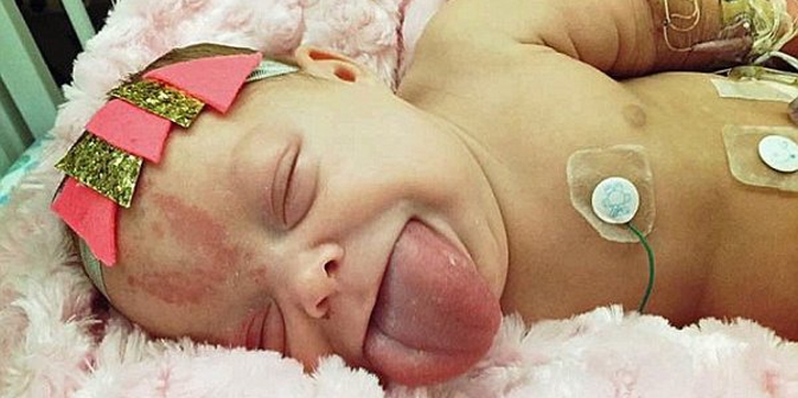 Bayi Berlidah Besar Ini Akhirnya Bisa Tersenyum