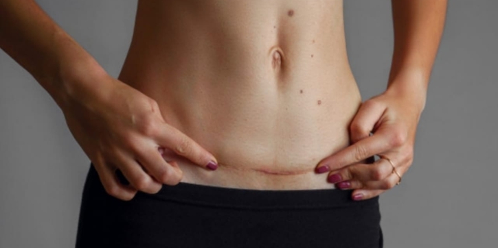 Cara Memijat Bekas Luka Operasi Caesar dan Manfaatnya