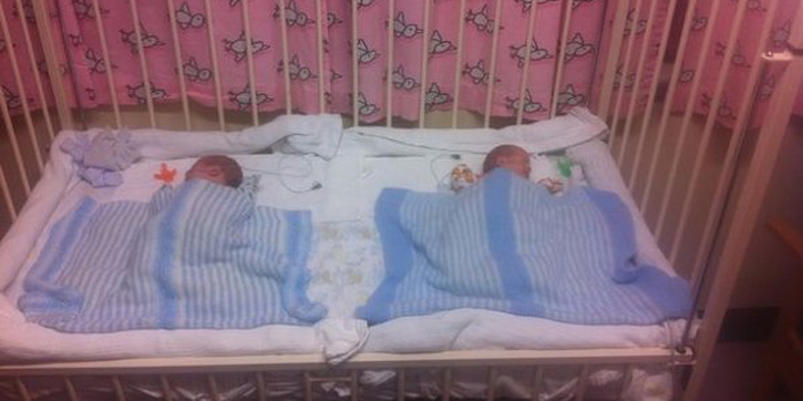 Si Kembar dengan Twin to Twin Transfusion Syndrome Bertahan Hidup