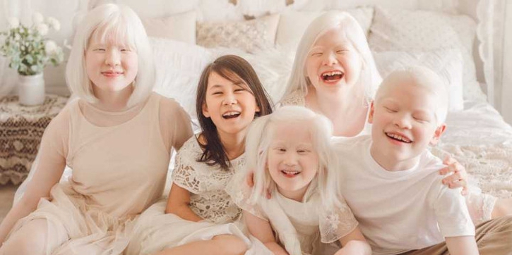 Yang Perlu Anda Ketahui tentang Anak Albino dan Penyebabnya