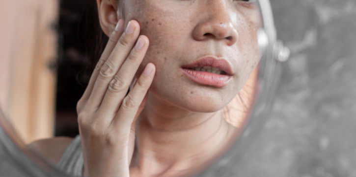 Melasma, Bercak Gelap di Wajah yang Sering Muncul saat Hamil