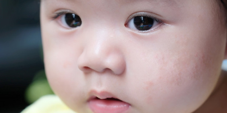 5 Penyebab Kulit Bayi Berjerawat dan Cara Mengatasinya