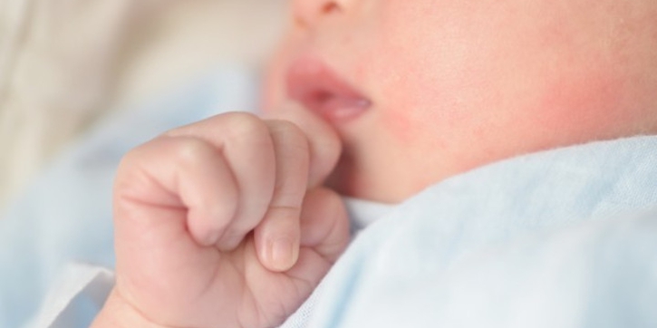 Kulit Bayi Bruntusan, Ini Penyebab dan Cara Mengatasinya