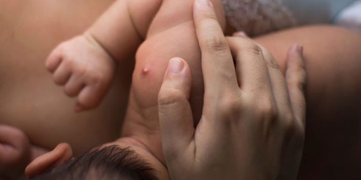 Kenali Penyebab dan Cara Atasi Bisulan pada Anak
