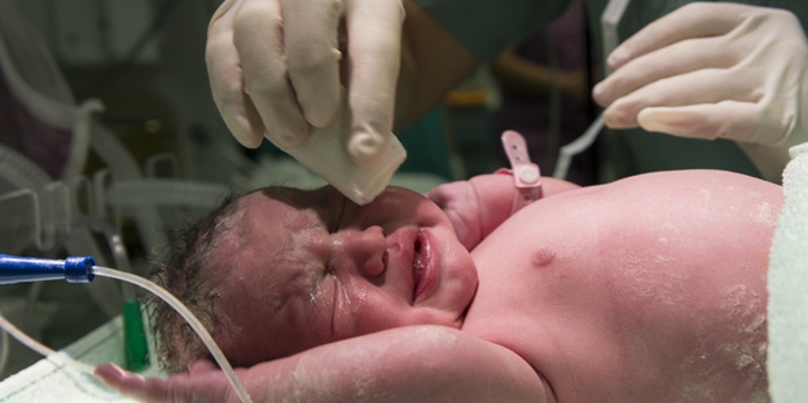 Mengenal Sindrom Putri Duyung, Cacat Kongenital Langka pada Bayi