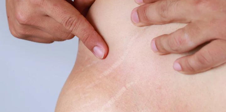 Cuma Bisa Pudar, Ini Perbedaan Stretch Mark Merah dan Putih