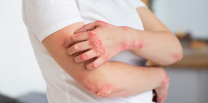 Tak Hanya Faktor Genetik, Stres Juga Bisa Menjadi Pemicu Psoriasis