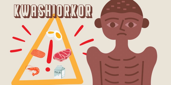 Kuku Anak Rapuh? Awas, Bisa Jadi Tanda Kwashiorkor, Lho!