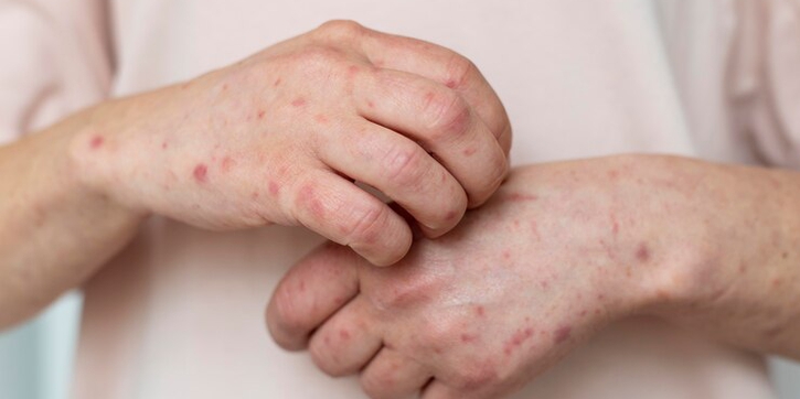 Kasus Meningkat, Waspadai Mpox atau Cacar Monyet, Ini Gejala dan Pencegahannya