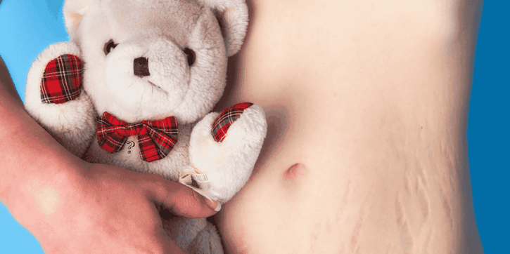 Cara Ampuh dan Aman untuk Menghilangkan Stretch Mark Setelah Melahirkan