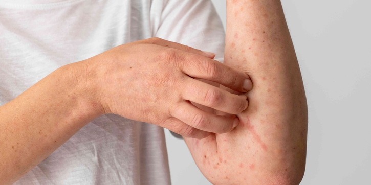 Jangan Keliru, Ini Perbedaan Campak dan Rubella yang Moms Perlu Tahu
