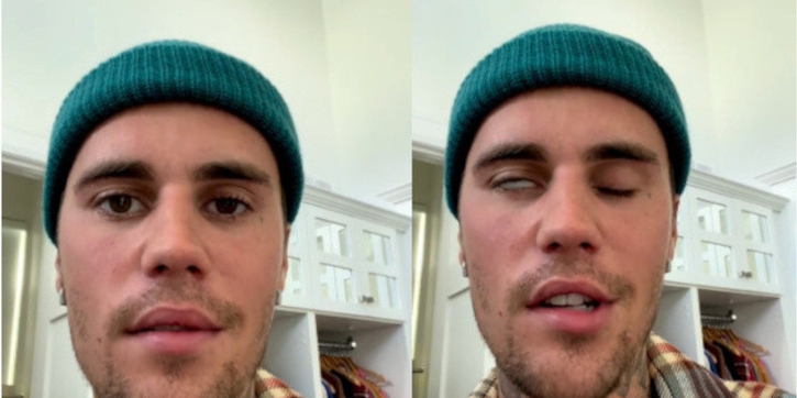 Kenali Ramsay Hunt Syndrome, Penyebab Wajah Justin Bieber Lumpuh