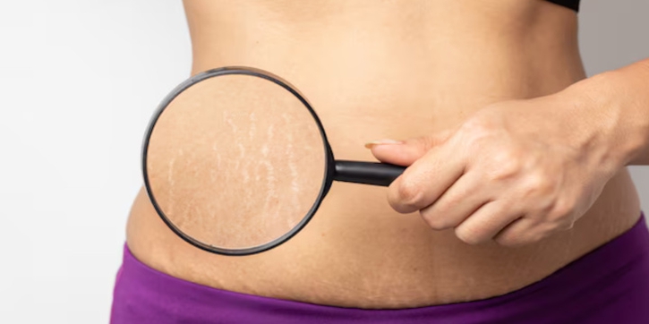 5 Cara Mengurangi Stretch Mark dengan Bahan Alami