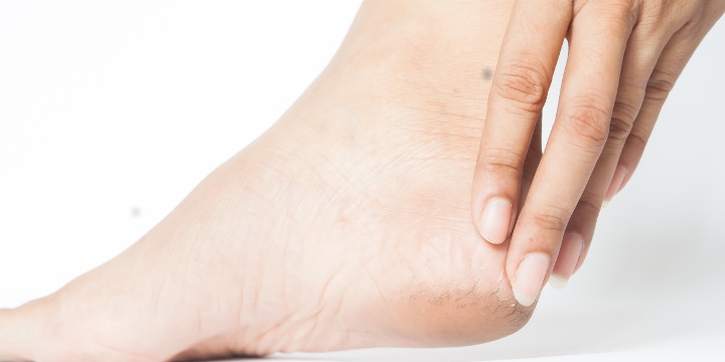 Kulit Kaki Kering dan Bersisik, Kenali Penyebab dan Cara Mengatasinya