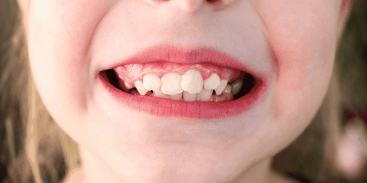 Gigi Berantakan pada Anak? Ini Cara Tepat Mengatasinya