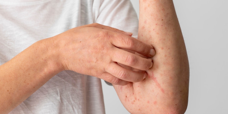 Mengenal Jenis-jenis Dermatitis dan Penyebabnya yang Perlu Anda Tahu