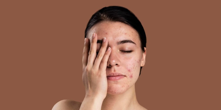 7 Tips Menghilangkan Bruntusan di Jidat dengan Cara Alami dan Efektif
