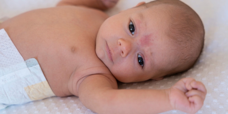 Scabies pada Bayi, Ini Gejala, Penyebab, dan Cara Mengatasinya