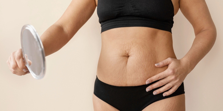 Kenapa Perut Hitam Setelah Melahirkan? Ini Penyebab dan Cara Mengatasinya