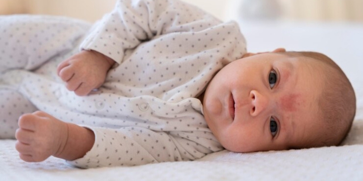 Infeksi Kulit pada Bayi, Ini Penyebab dan Cara Mencegahnya