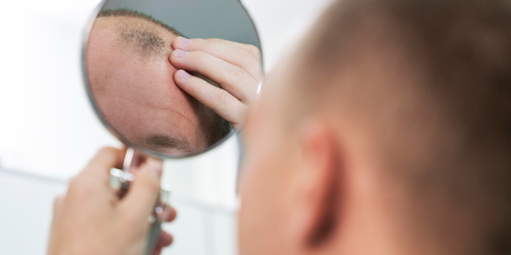 6 Hal yang Perlu Diketahui Seputar Tanam Rambut