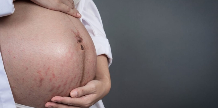Rahasia Merawat Stretch Marks dengan Perawatan Kulit yang Tepat