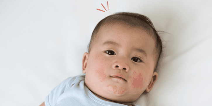 Penyebab Kulit Bayi Kemerahan dan Cara Tepat untuk Mengatasinya