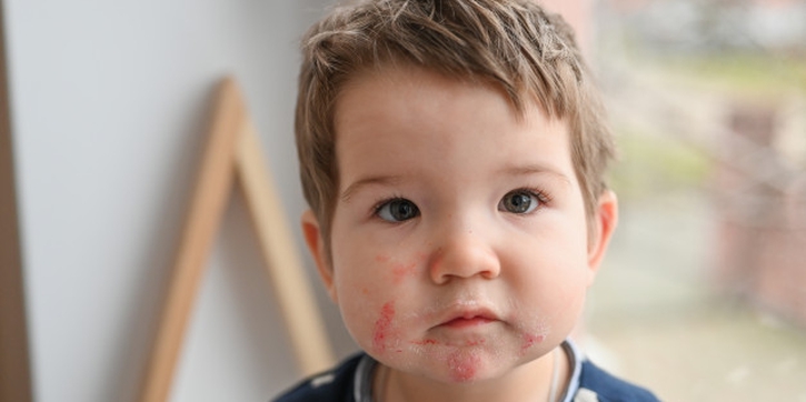 World Allergy Week 2020: Cara Cegah Alergi Anak dari Rumah
