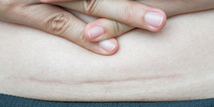 Rekomendasi Penghilang Bekas Luka Akibat Caesar